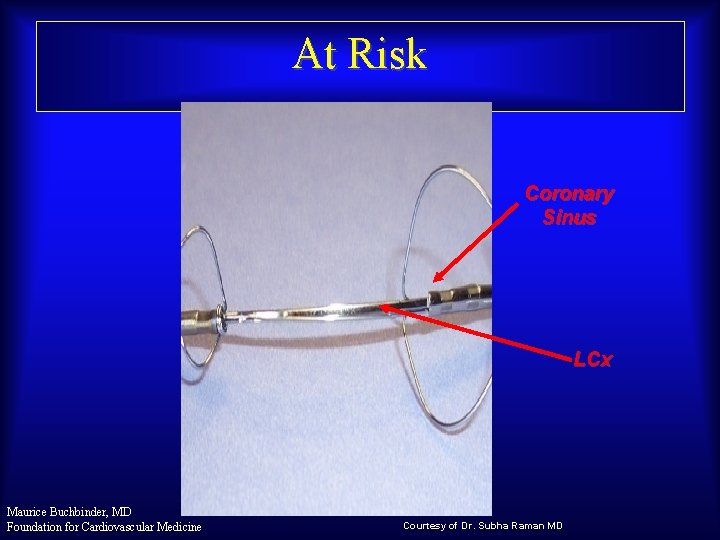 At Risk Coronary Sinus LCx Maurice Buchbinder, MD Foundation for Cardiovascular Medicine Courtesy of