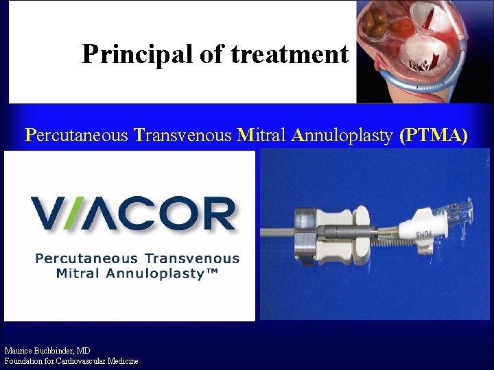 Principal of treatment Percutaneous Transvenous Mitral Annuloplasty (PTMA) Maurice Buchbinder, MD Foundation for Cardiovascular