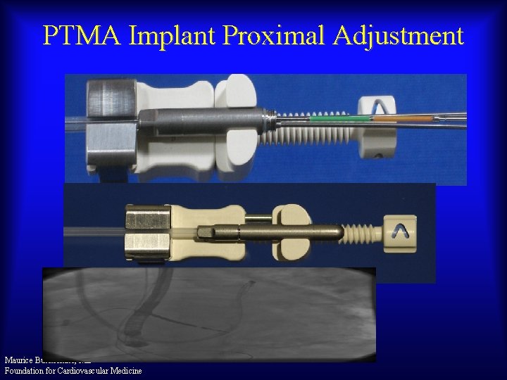 PTMA Implant Proximal Adjustment Maurice Buchbinder, MD Foundation for Cardiovascular Medicine 