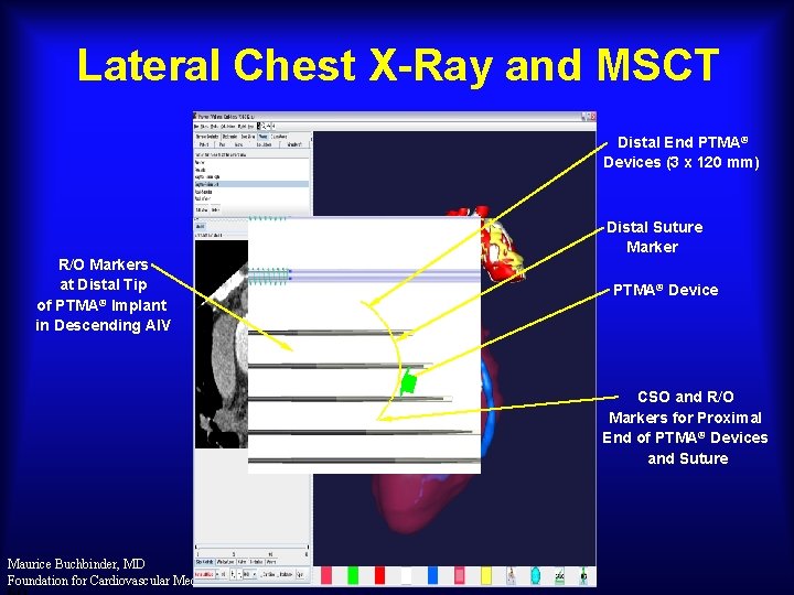 Lateral Chest X-Ray and MSCT Distal End PTMA® Devices (3 x 120 mm) Distal