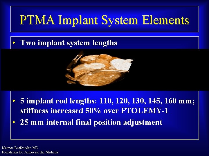 PTMA Implant System Elements • Two implant system lengths • 5 implant rod lengths: