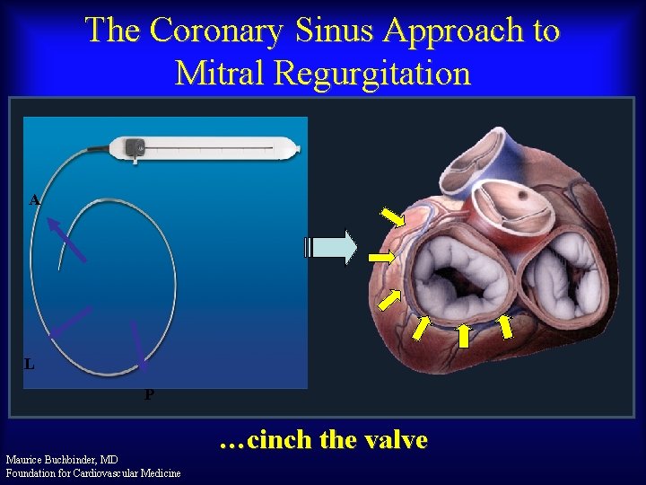 The Coronary Sinus Approach to Mitral Regurgitation A L P Maurice Buchbinder, MD Foundation