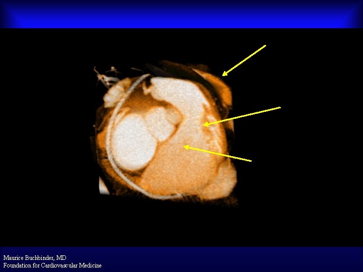 Tether Section in Right Atrium Proximal R/O Marker Treatment Section Engaging CSO Posterior View