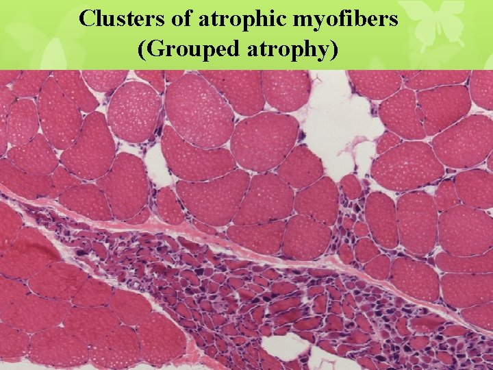 Clusters of atrophic myofibers (Grouped atrophy) 