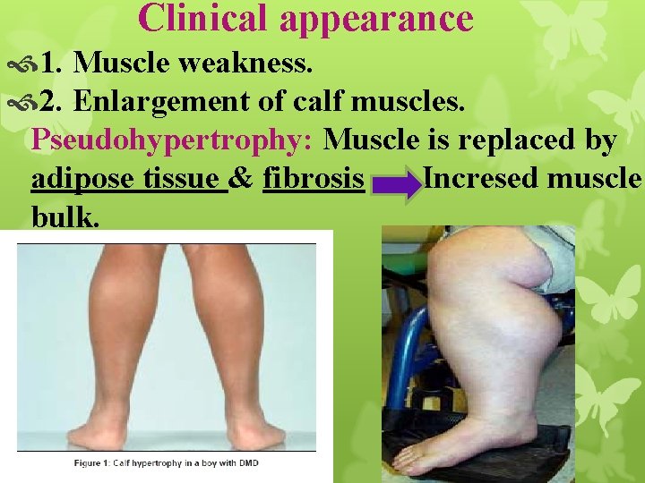 Clinical appearance 1. Muscle weakness. 2. Enlargement of calf muscles. Pseudohypertrophy: Muscle is replaced
