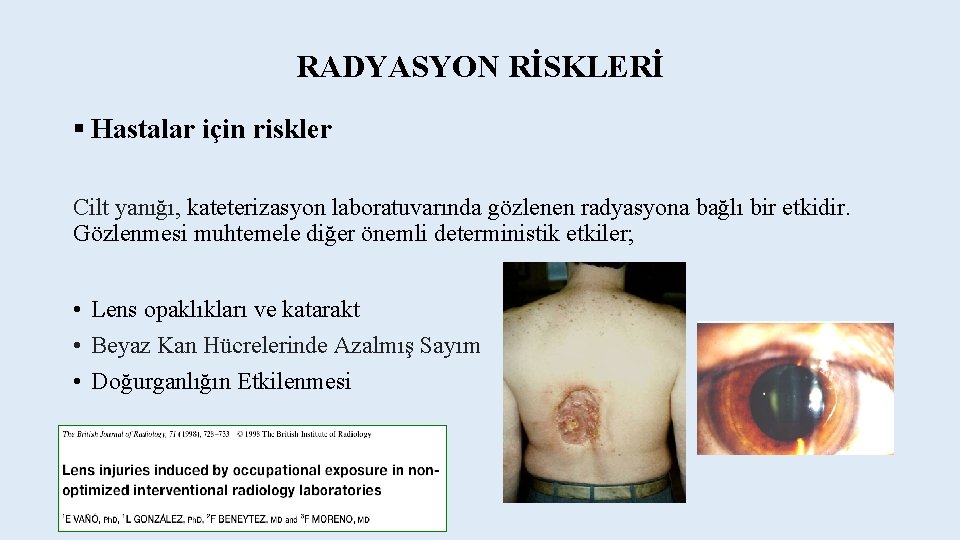 RADYASYON RİSKLERİ § Hastalar için riskler Cilt yanığı, kateterizasyon laboratuvarında gözlenen radyasyona bağlı bir