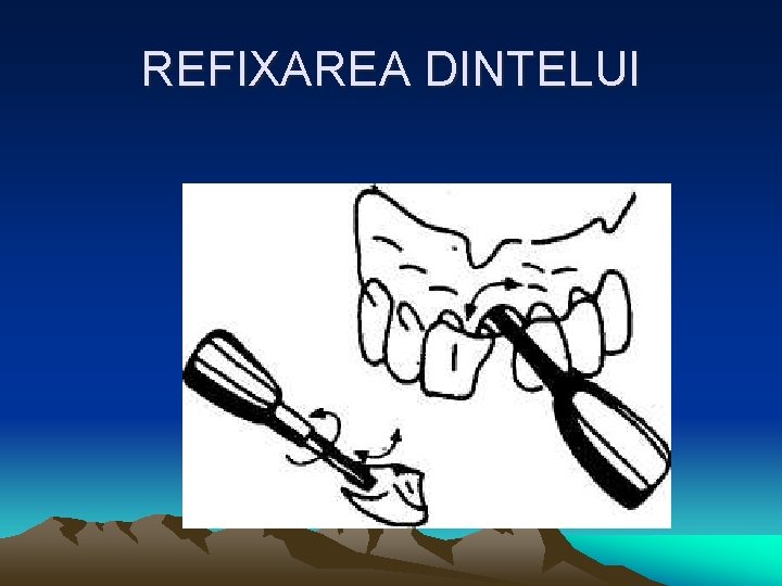 REFIXAREA DINTELUI 