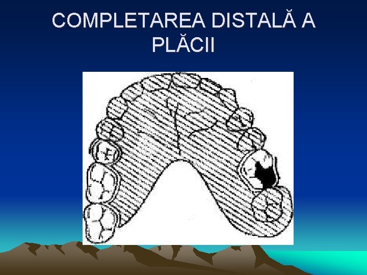 COMPLETAREA DISTALĂ A PLĂCII 