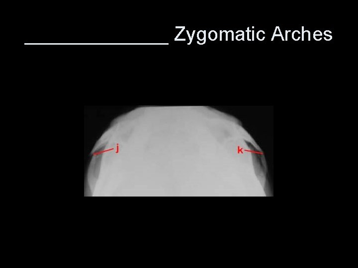 _______ Zygomatic Arches 