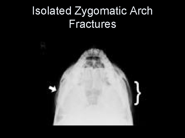 Isolated Zygomatic Arch Fractures 