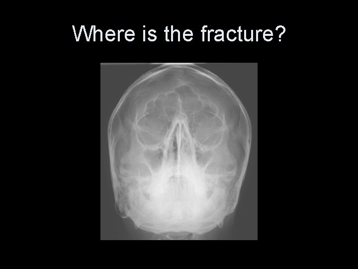 Where is the fracture? 