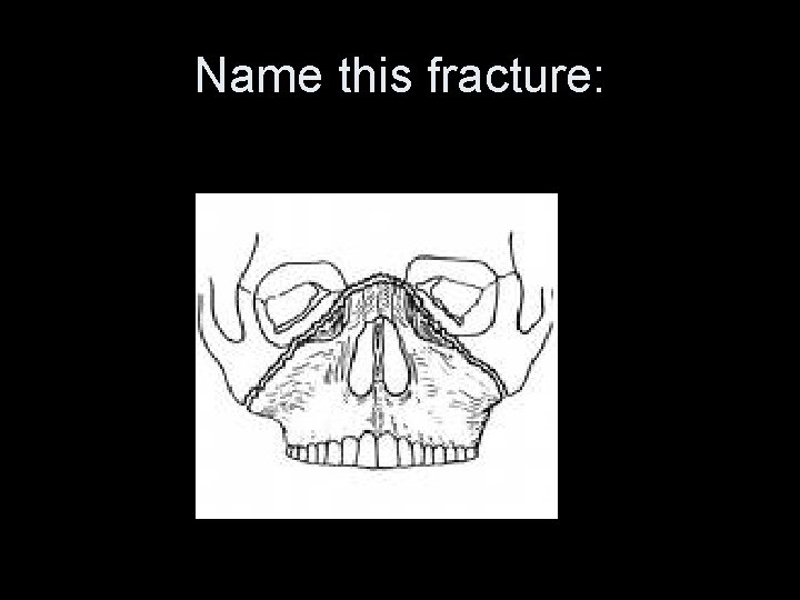 Name this fracture: 