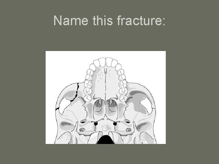 Name this fracture: 