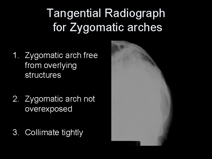 Tangential Radiograph for Zygomatic arches 1. Zygomatic arch free from overlying structures 2. Zygomatic