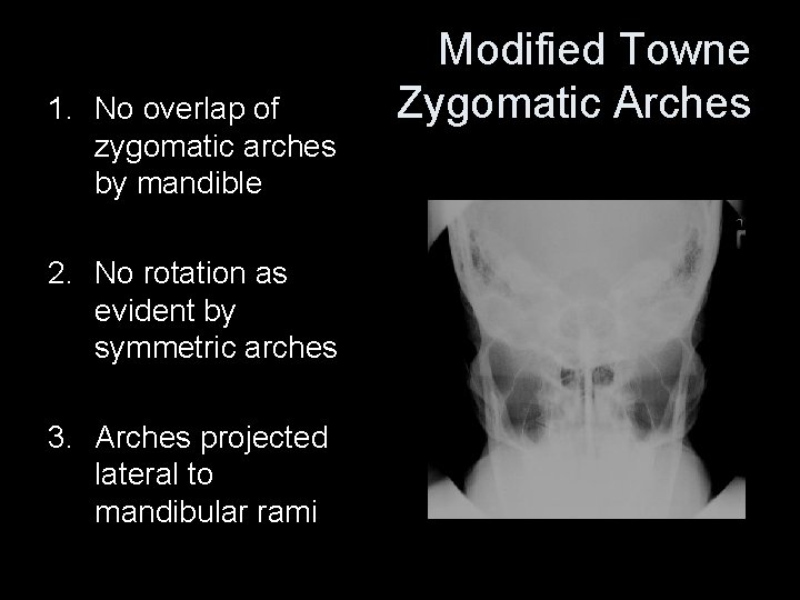 1. No overlap of zygomatic arches by mandible 2. No rotation as evident by