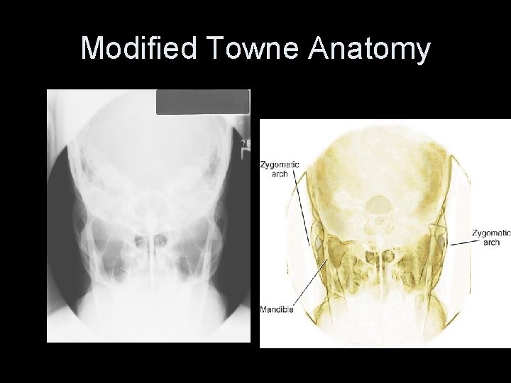 Modified Towne Anatomy 