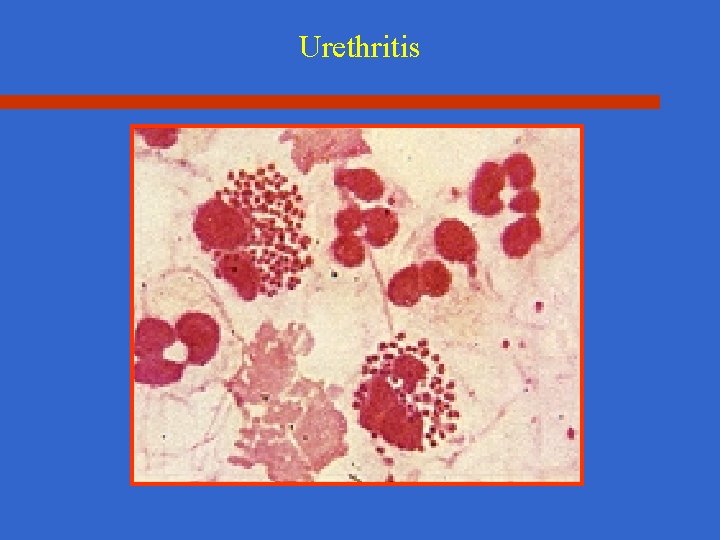 Urethritis 