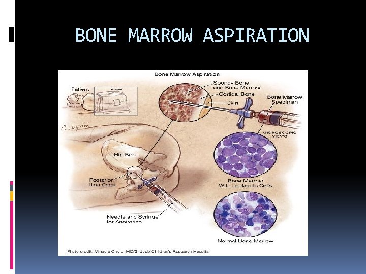 BONE MARROW ASPIRATION 