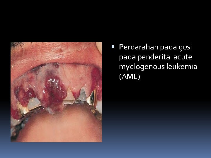  Perdarahan pada gusi pada penderita acute myelogenous leukemia (AML) 