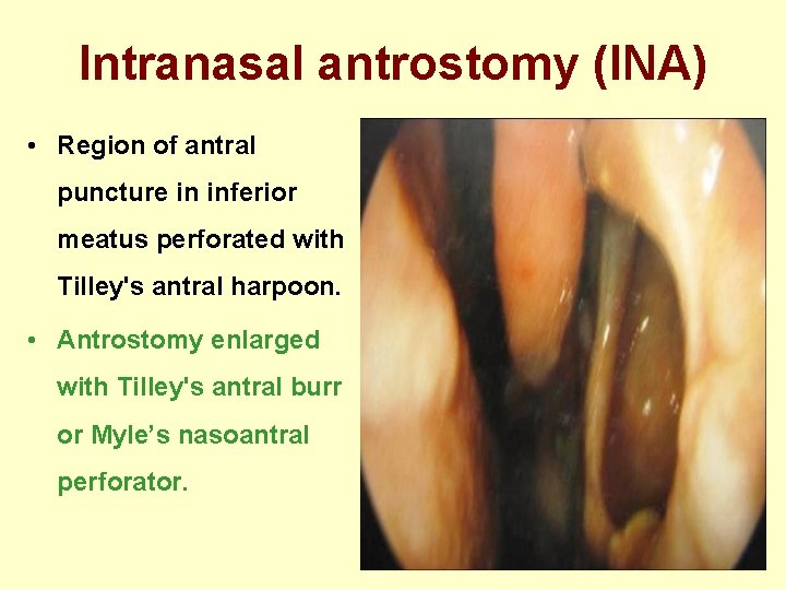 Intranasal antrostomy (INA) • Region of antral puncture in inferior meatus perforated with Tilley's
