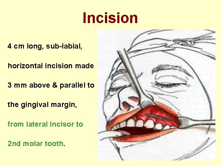 Incision 4 cm long, sub-labial, horizontal incision made 3 mm above & parallel to