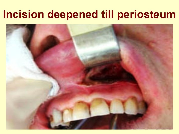 Incision deepened till periosteum 