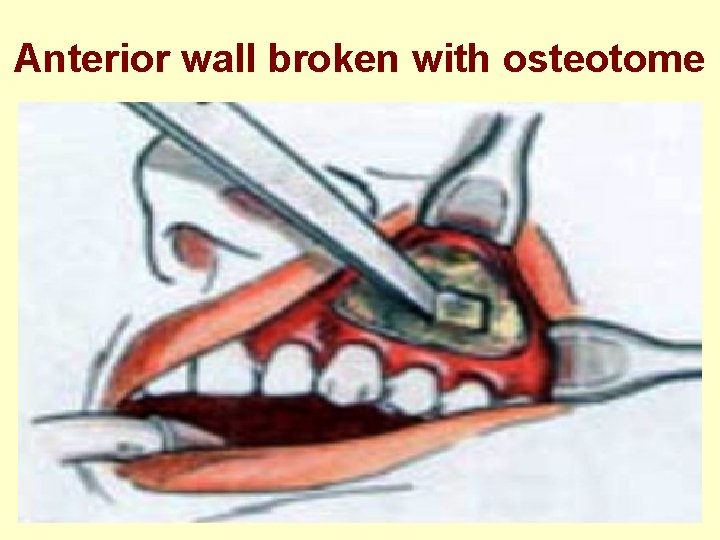 Anterior wall broken with osteotome 