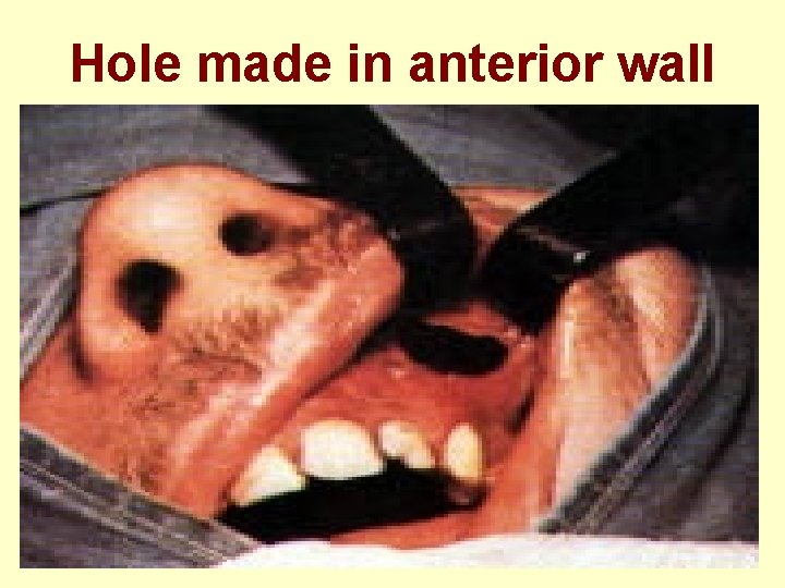 Hole made in anterior wall 