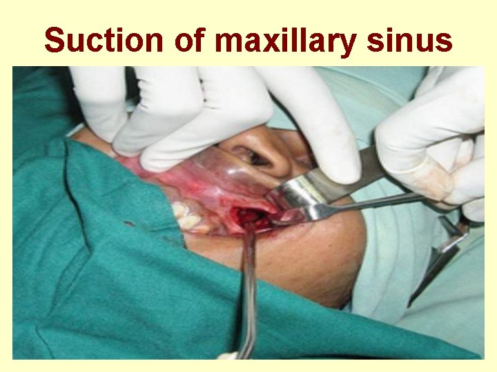 Suction of maxillary sinus 