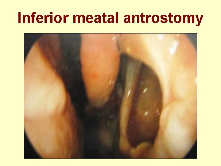 Inferior meatal antrostomy 