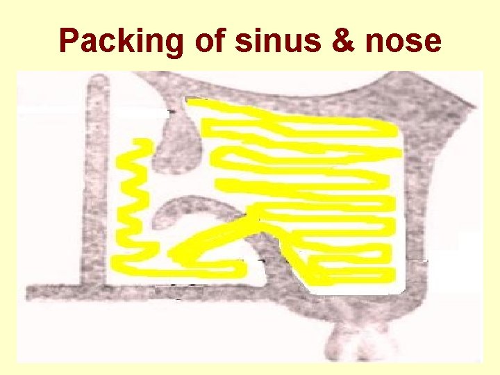 Packing of sinus & nose 