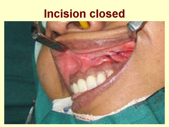 Incision closed 