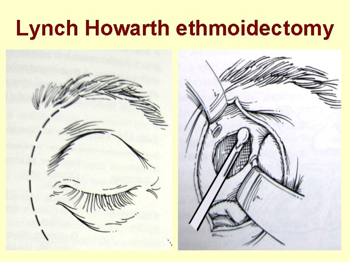 Lynch Howarth ethmoidectomy 