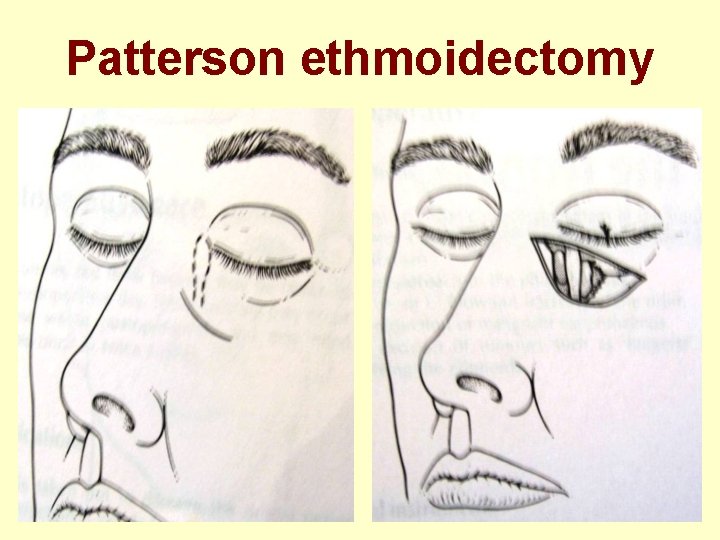 Patterson ethmoidectomy 