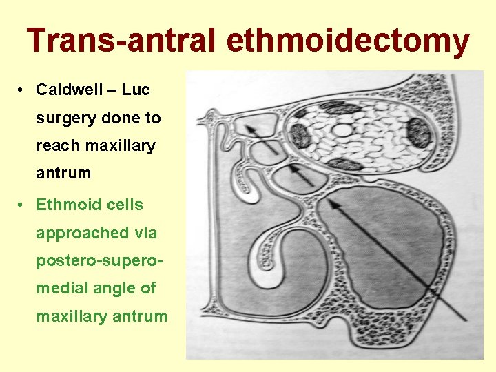 Trans-antral ethmoidectomy • Caldwell – Luc surgery done to reach maxillary antrum • Ethmoid