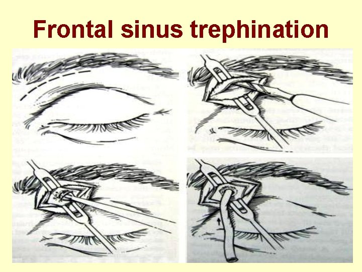 Frontal sinus trephination 