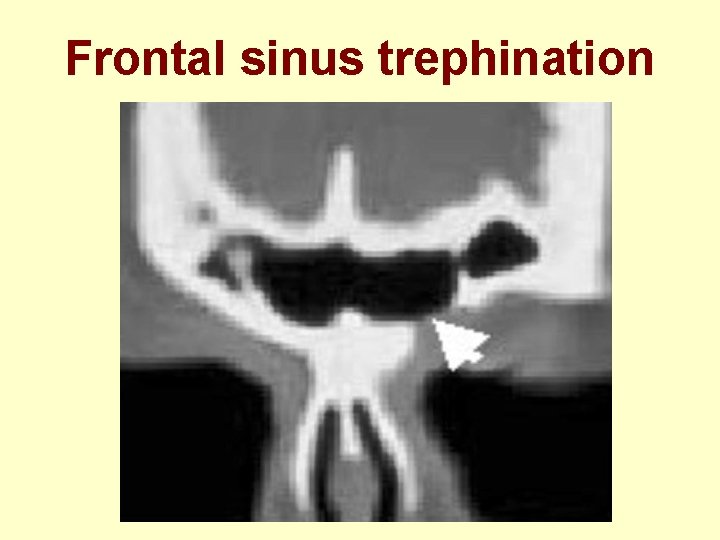 Frontal sinus trephination 