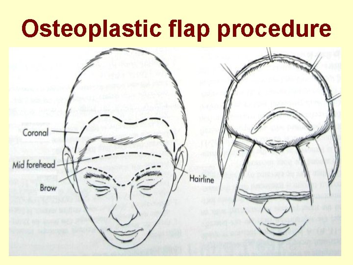 Osteoplastic flap procedure 