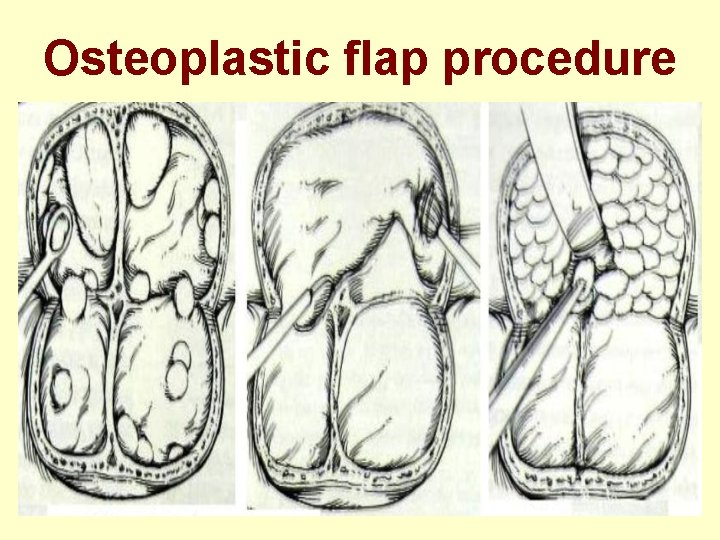 Osteoplastic flap procedure 