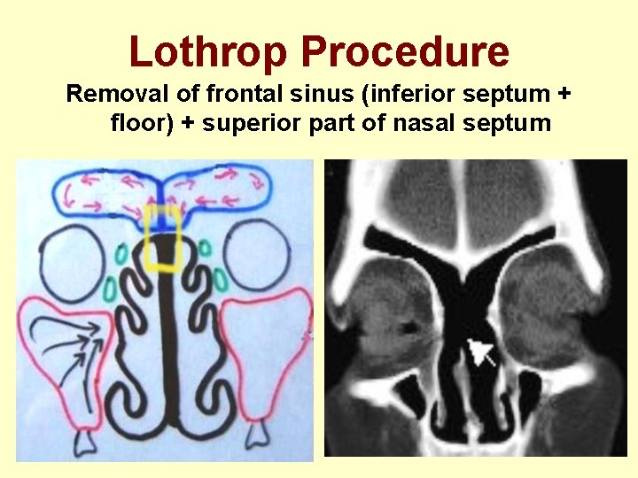 Lothrop Procedure Removal of frontal sinus (inferior septum + floor) + superior part of