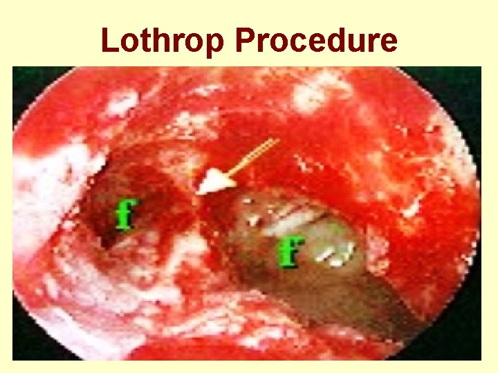 Lothrop Procedure 