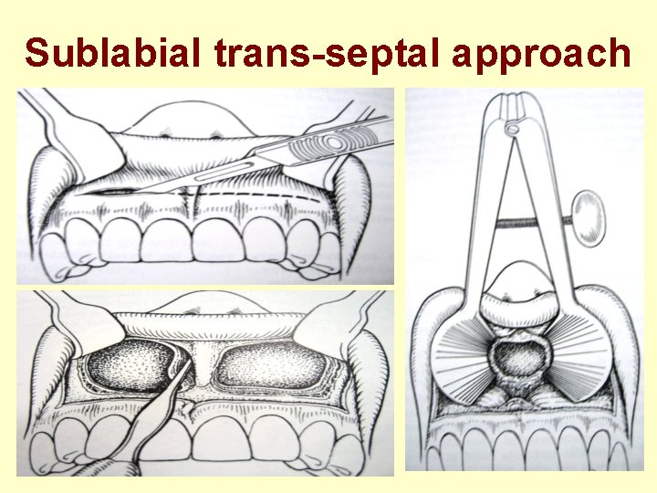 Sublabial trans-septal approach 