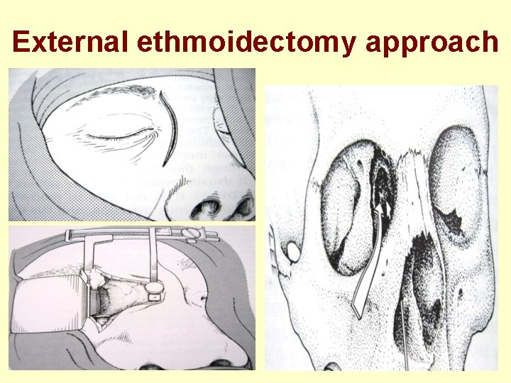 External ethmoidectomy approach 