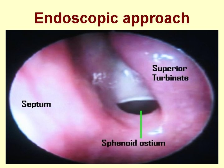 Endoscopic approach 