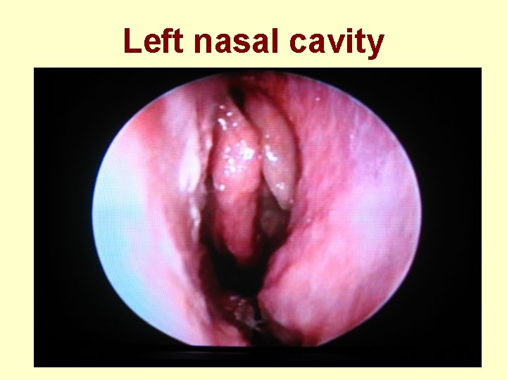 Left nasal cavity 