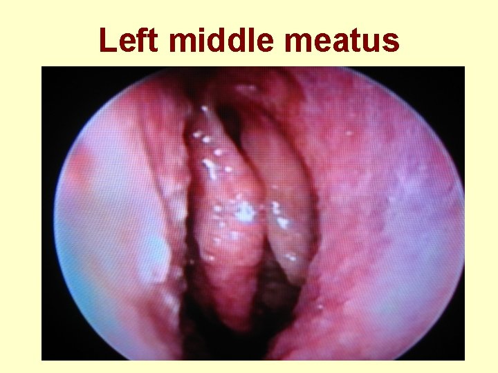 Left middle meatus 