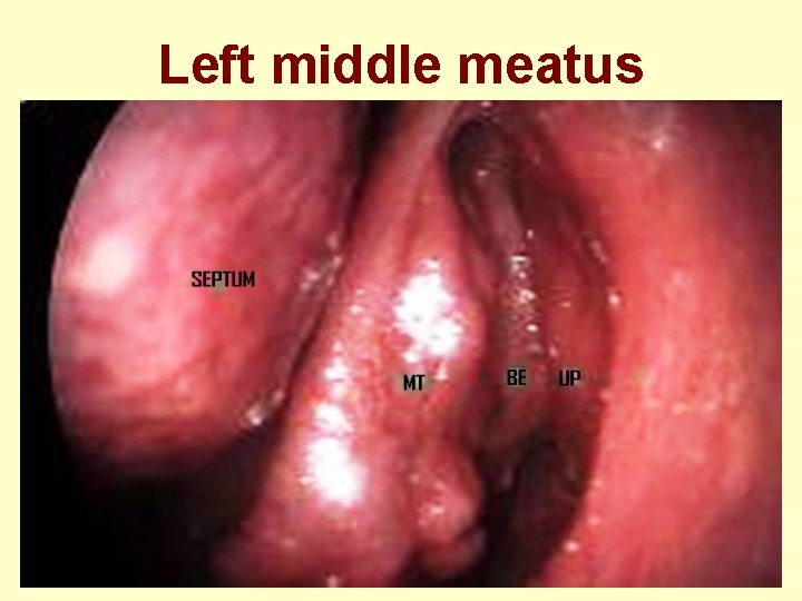 Left middle meatus 