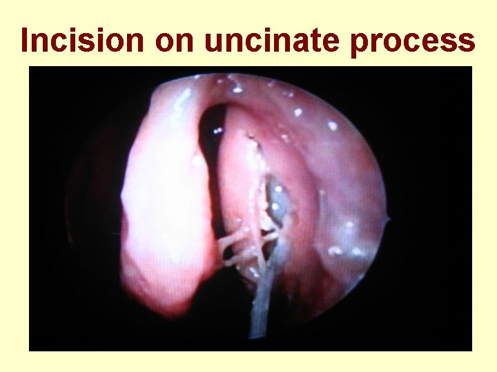 Incision on uncinate process 