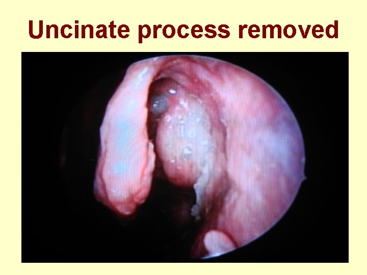 Uncinate process removed 