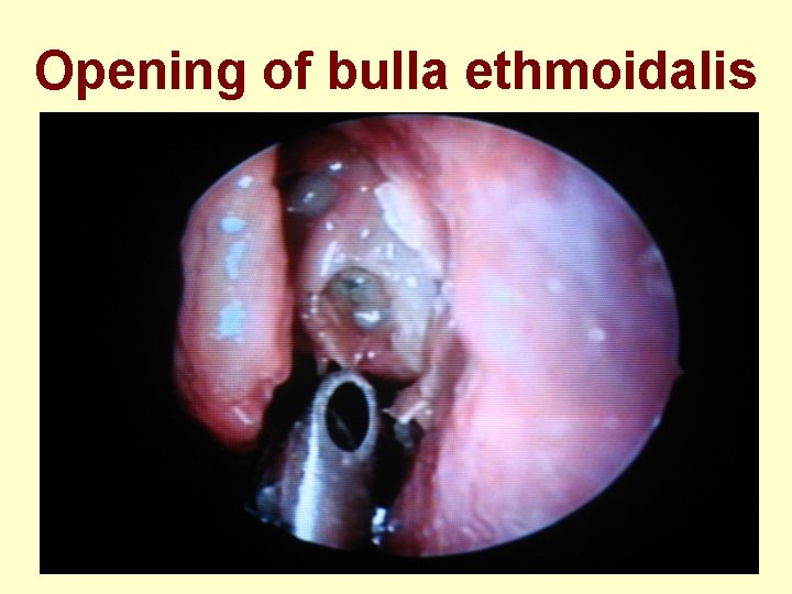 Opening of bulla ethmoidalis 